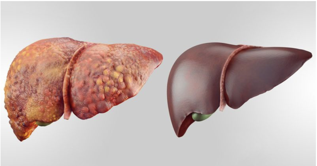 Hígado Graso y Fructosa: las causas reales | Low Carb Chile